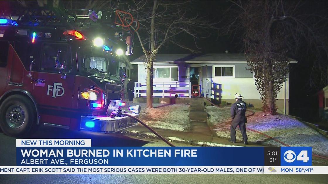 North County woman burned in overnight house fire on Albert Avenue in Ferguson, The woman’s face was burned in the fire.